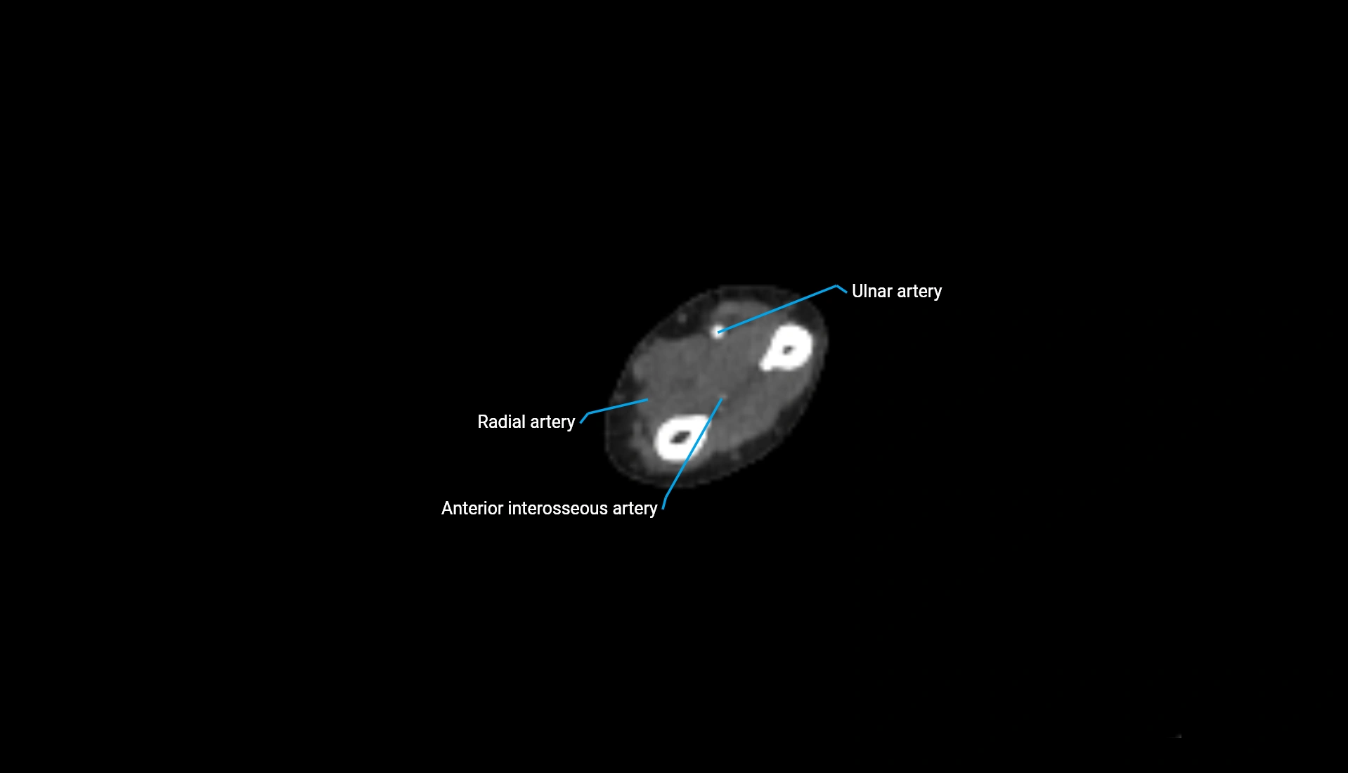 CTA upper limb axial cross sectional anatomy labelled image 116 (2).webp